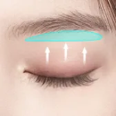 Sub-brow Lift