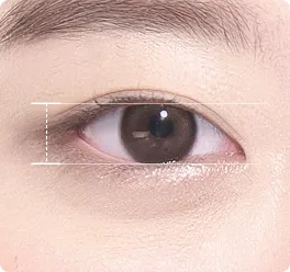 輕度下垂