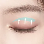 FOREVER Forehead & Sub-brow Lift