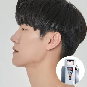 Men's Laser Hair Removal