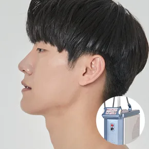男士激光脱毛