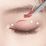 FOREVER Forehead & Sub-brow Lift