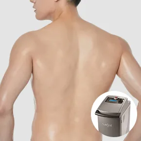 男士激光脱毛