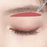 FOREVER Forehead & Sub-brow Lift