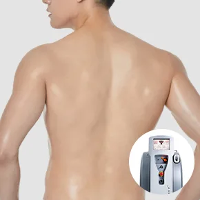 Men's Laser Hair Removal
