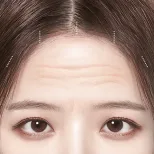 FOREVER Forehead & Sub-brow Lift