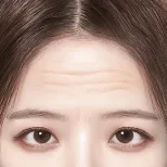 FOREVER Forehead & Sub-brow Lift
