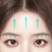 FULL HD Endoscopic Forehead Lift