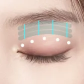 Ptosis Correction